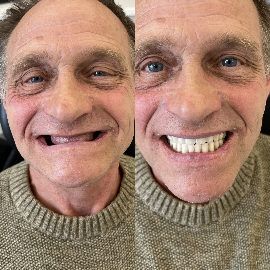 Before and after full mouth implants by Dr Naseer